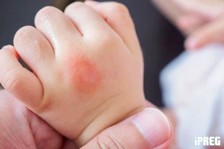 Vết thương kiến ba khoang đốt